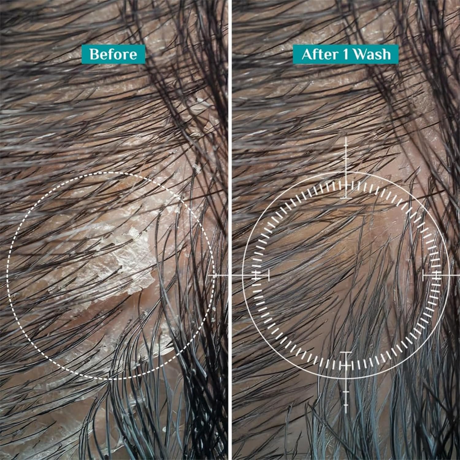 Pilgrim Australian Tea Tree Non-Drying Anti-Dandruff Shampoo 200 ml | Removes Dandruff from Source | Helps with Itching, Irritation | Strong & Smooth Hair | For Men & Women - Image 5